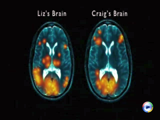 5 - Craig's brain shows no activation at all in this emotional part of the brain